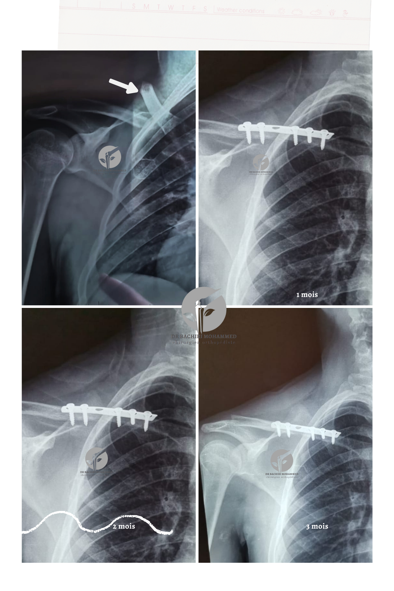 Fracture de la clavicule traitée par Dr. Bachiri Mohammed à Oujda